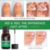 Toenail Solution Extra Strength – Athlete’s Foot, Toe & Finger Nail Treatment